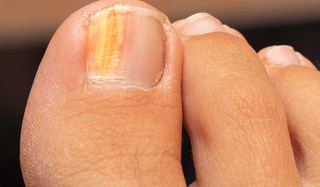 Tırnaktaki Bu Değişiklik Cilt Kanseri Habercisi Olabilir: Uzmanlar Uyardı