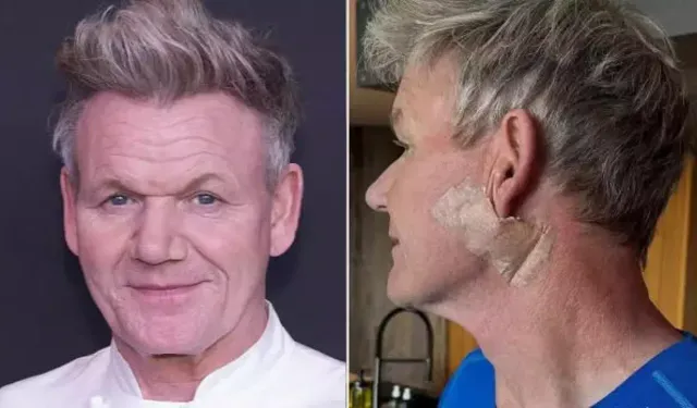 Gordon Ramsay'e cilt kanseri teşhisi